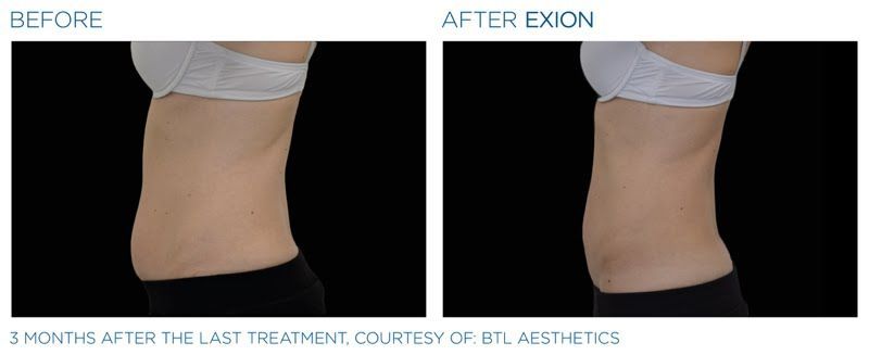 A before and after picture of a woman 's stomach.