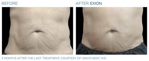 A before and after picture of a man 's stomach.