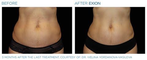 A before and after picture of a woman 's stomach.