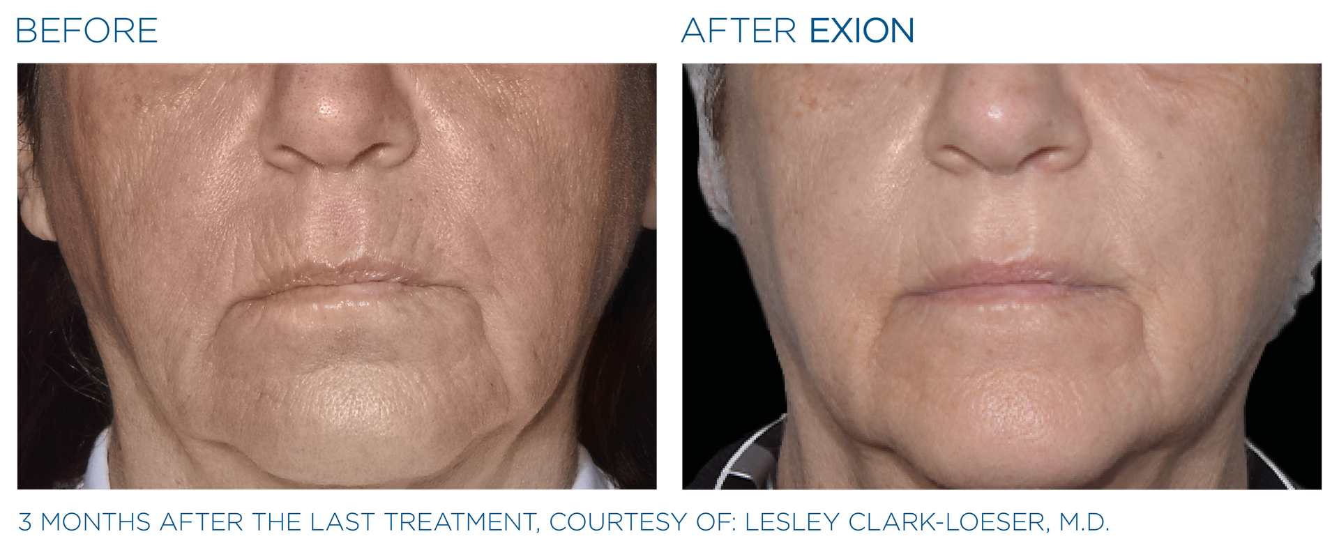 A before and after photo of a woman 's face.