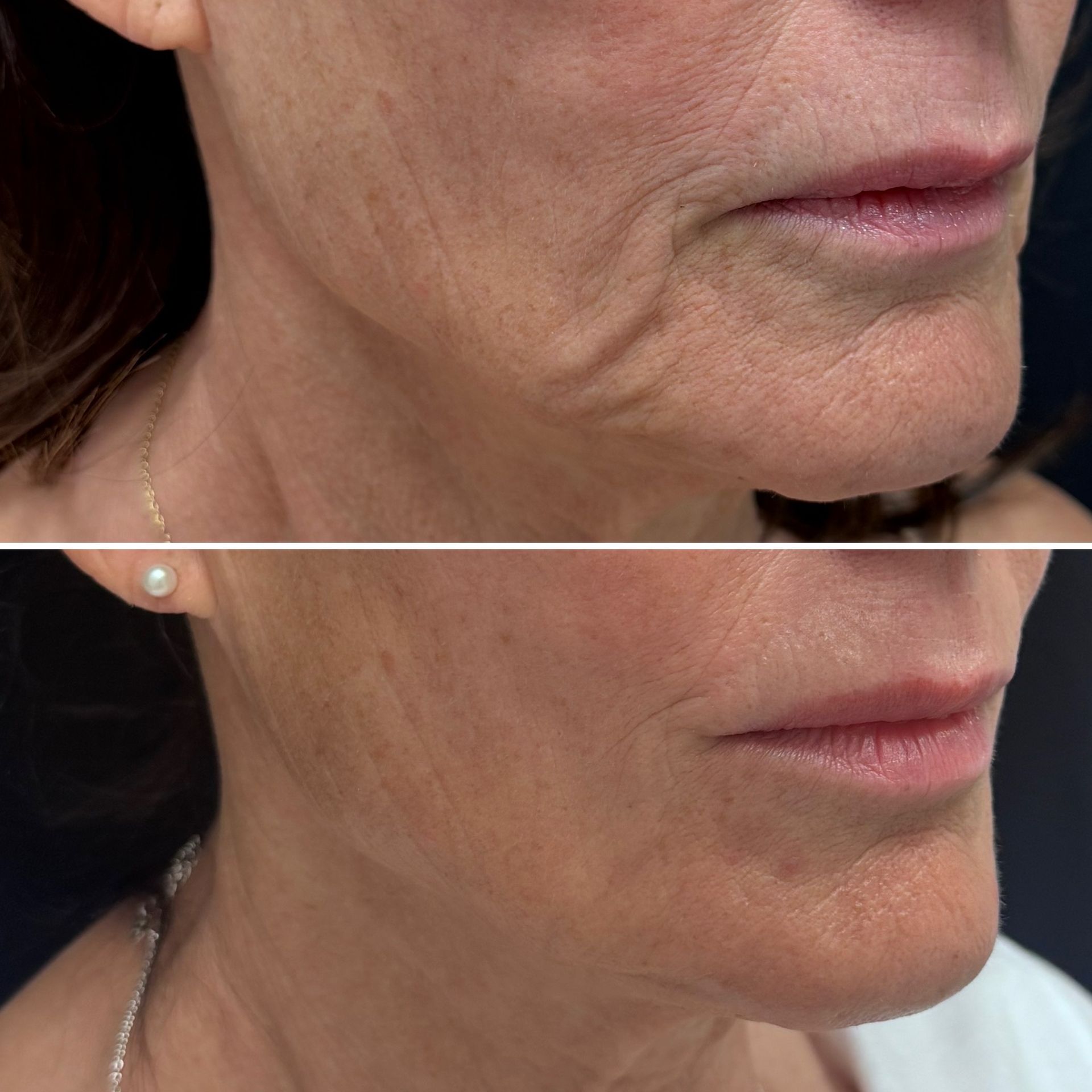 Before and after XERF skin tightening treatment in a female client's right cheek
