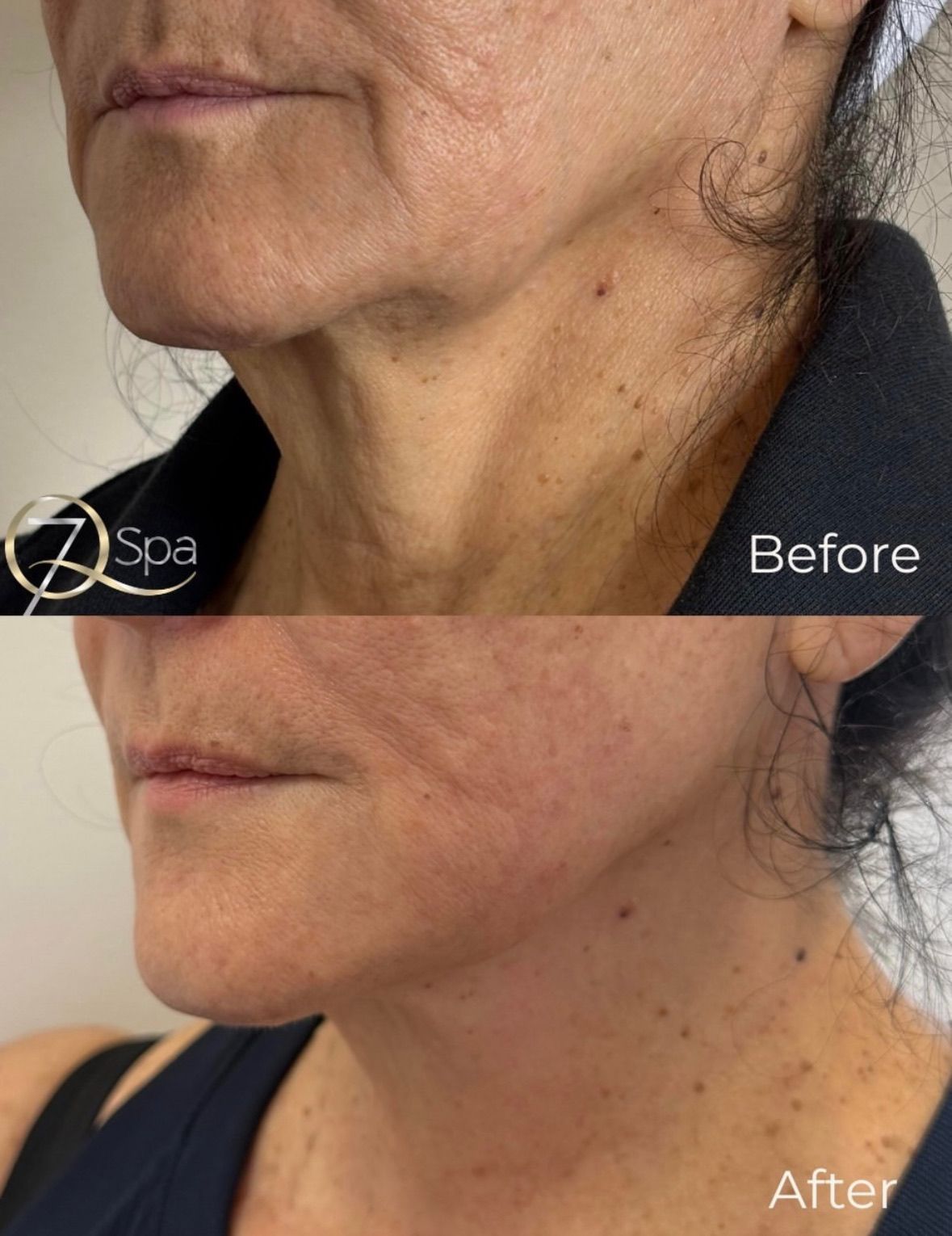 Before and after XERF skin tightening treatment around the cheek and neck area of a female client of Vitatherapy in Temecula, CA