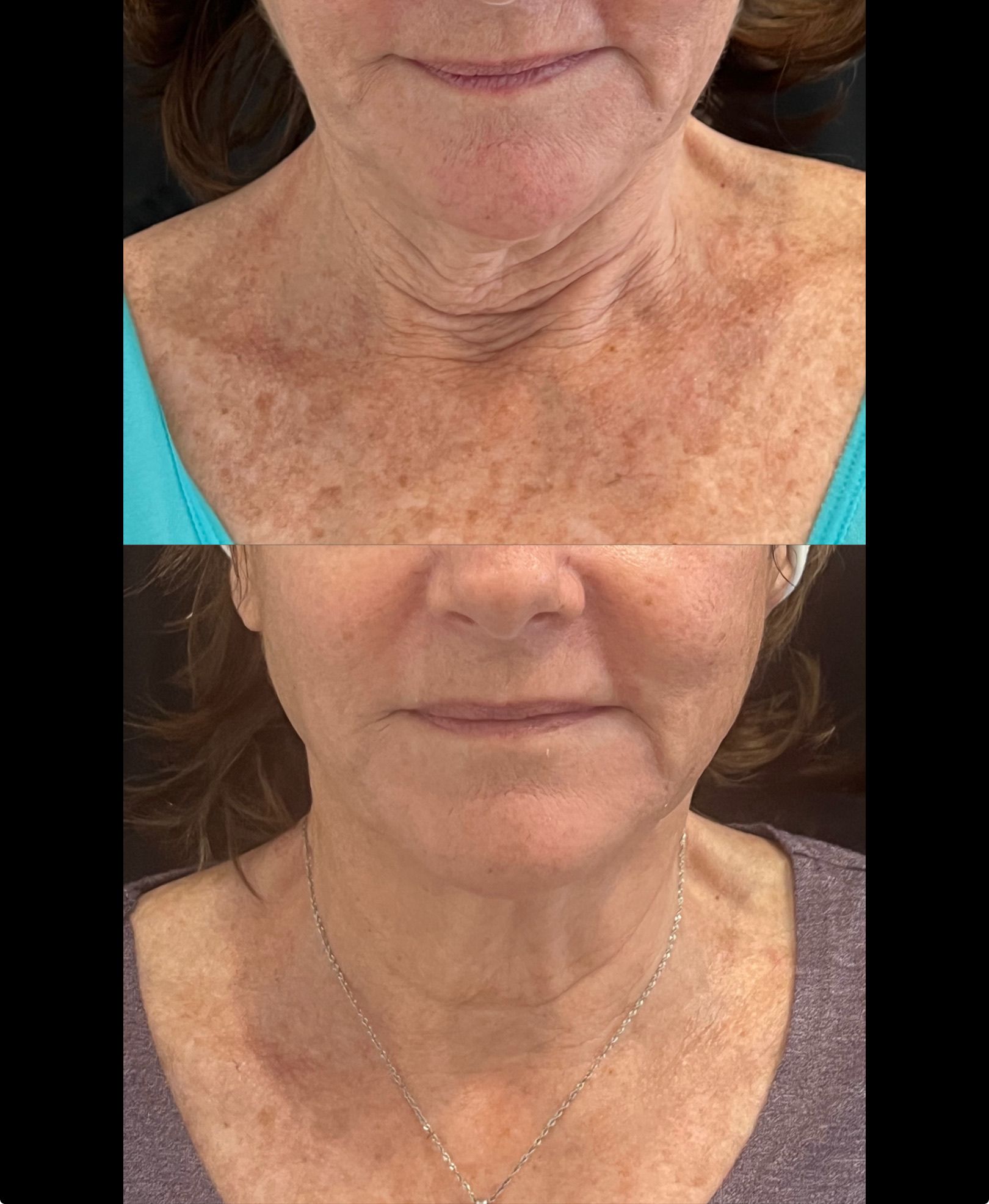 Before and after XERF skin tightening treatment around the neck area of a female client