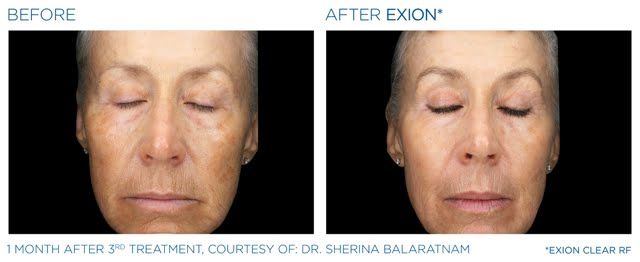 A before and after photo of a woman 's face with her eyes closed.