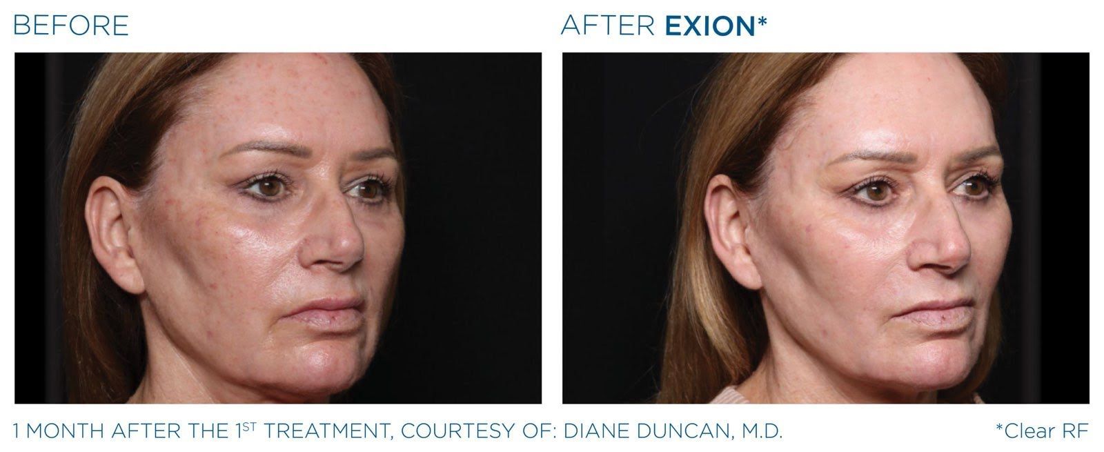 A before and after photo of a woman 's face.