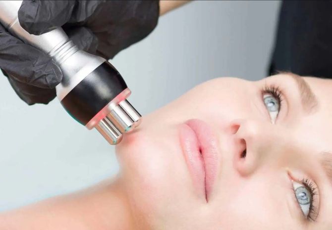 Peptides RF laser skin tightening treatment to improve skin firmness, texture, and promote collagen production