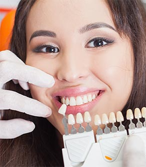 dental veneers
