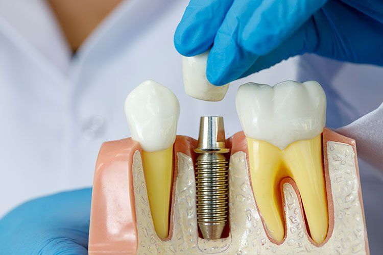 Dental Implants