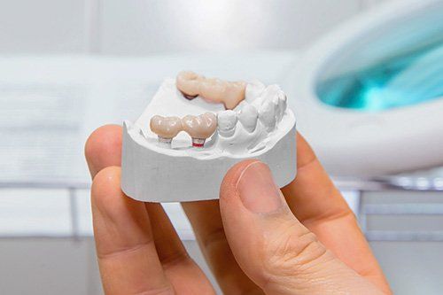 Dental Crowns and Bridges