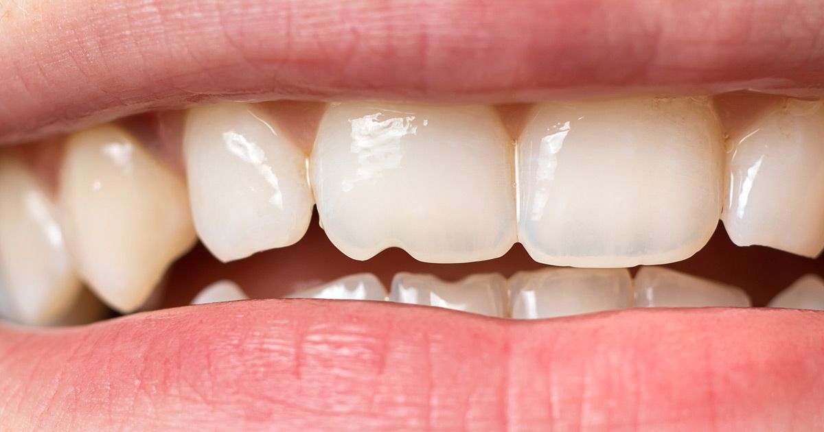 teeth chipping