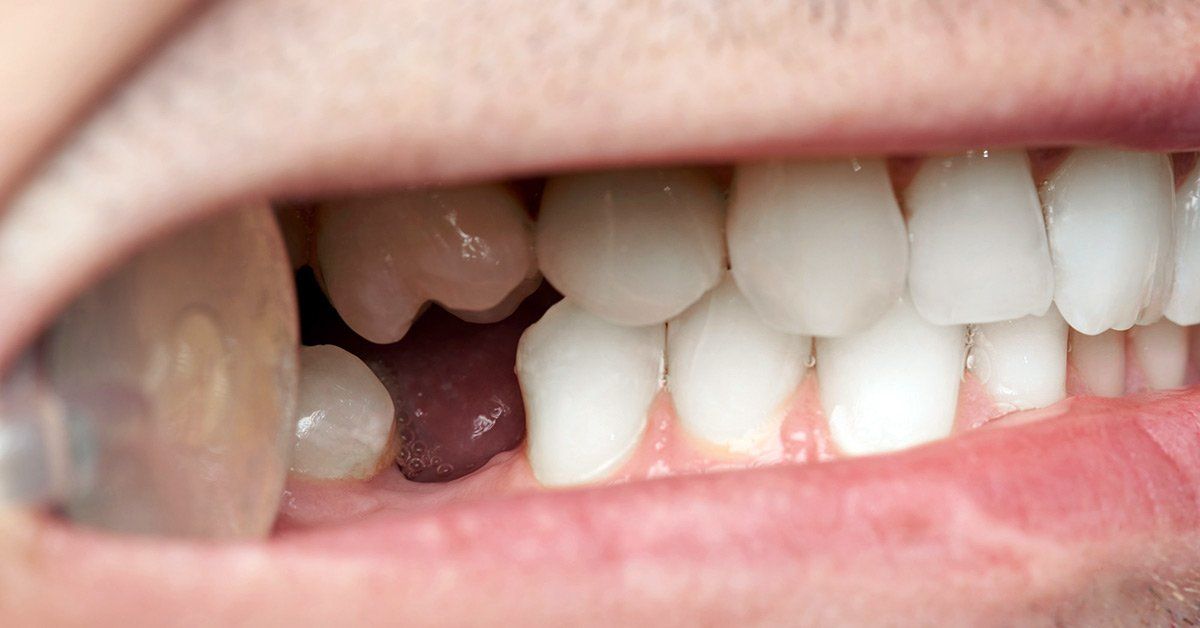 Emergency Dentist Mount Vernon