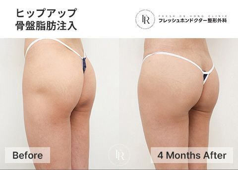 韓国豊尻手術｜江南ソウル Fresh Dr. Hong Clinic