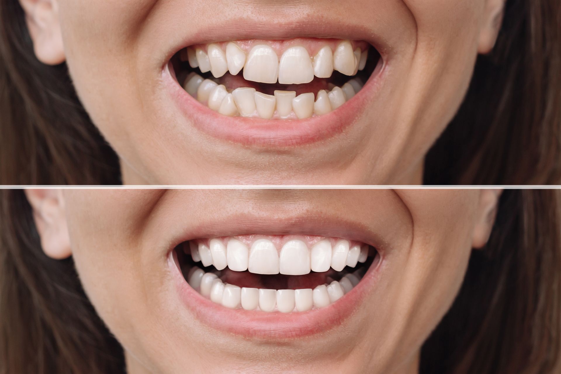 Cropped shot of a woman before and after the correction of uneven teeth with braces