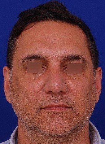 male rhinoplasty