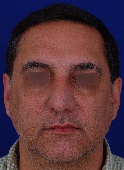 male rhinoplasty