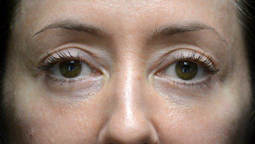 after lower blepharoplasty