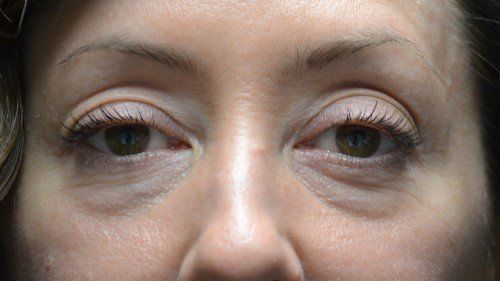 before lower blepharoplasty