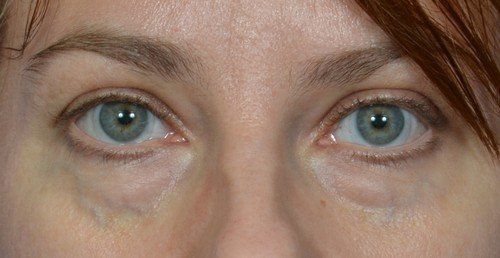 blepharoplasty before and after