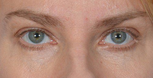 blepharoplasty before and after