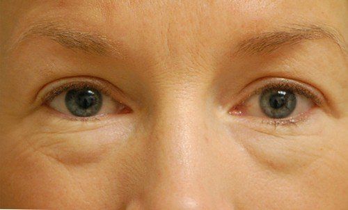 before blepharoplasty