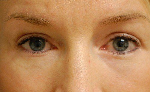 after blepharoplasty