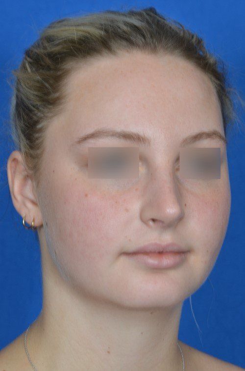 female rhinoplasty