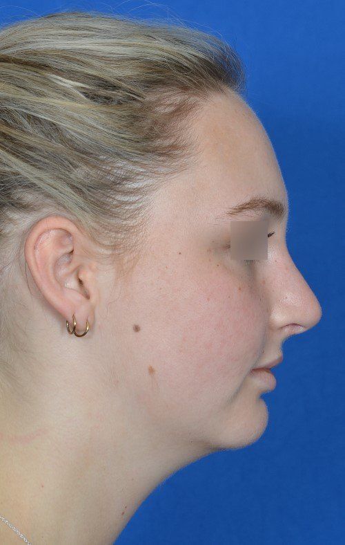 rhinoplasty side view