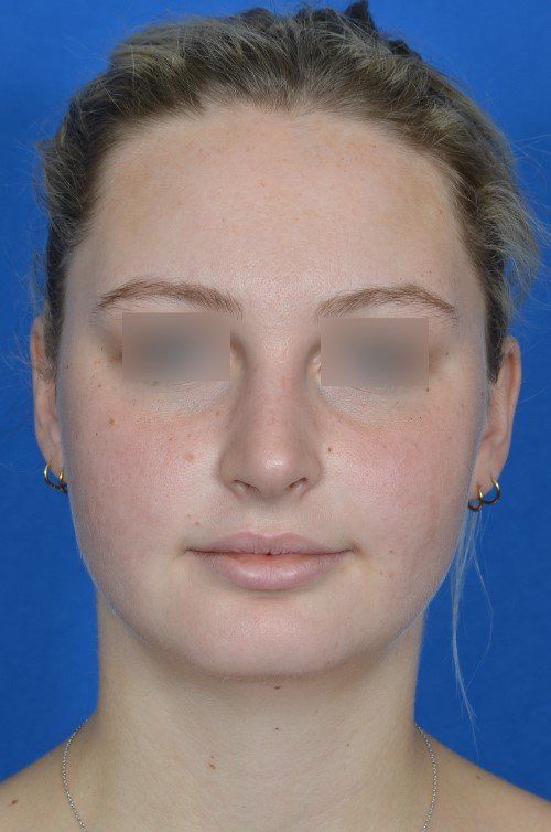 female rhinoplasty