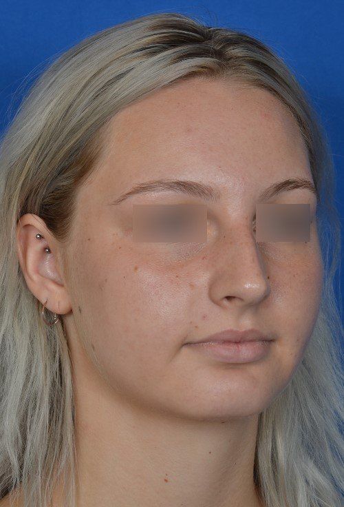 female rhinoplasty