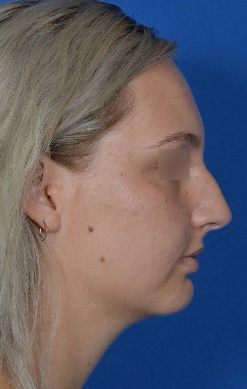 rhinoplasty