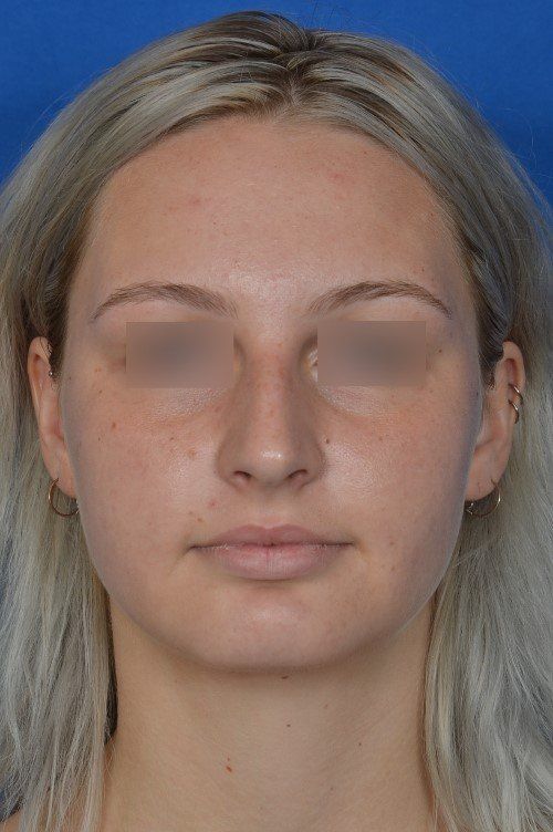 female rhinoplasty