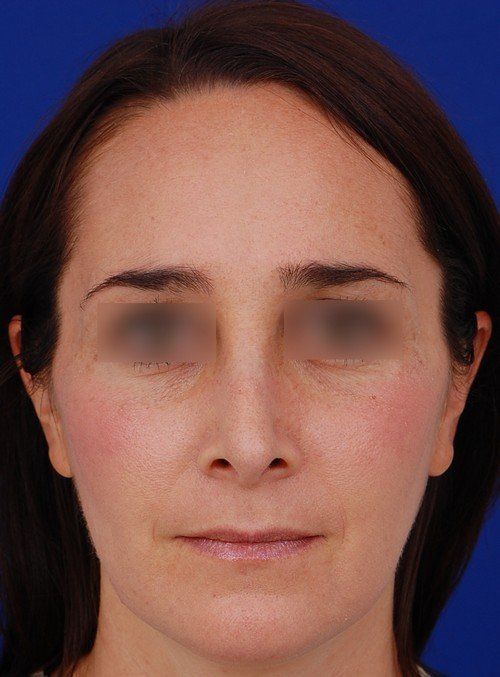 female revision rhinoplasty