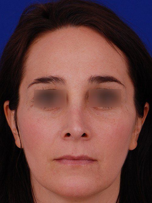 female revision rhinoplasty