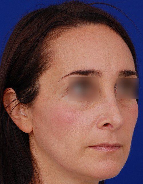 female revision rhinoplasty