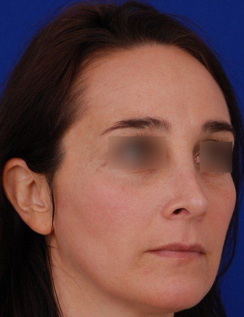 female revision rhinoplasty