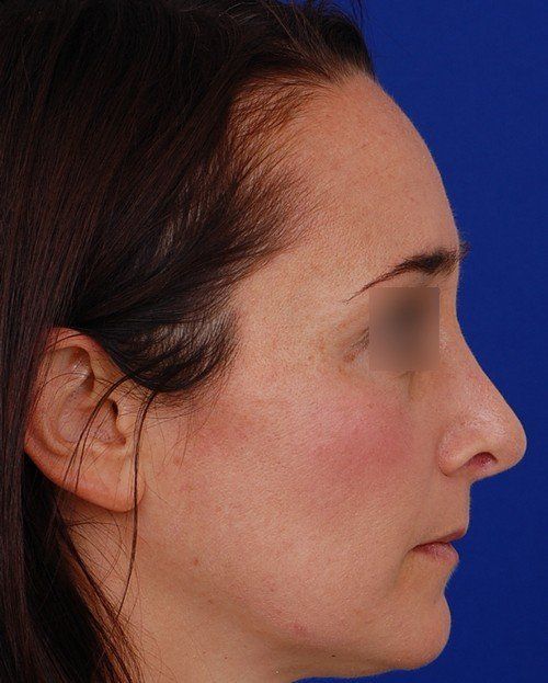 revision rhinoplasty