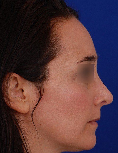 female revision rhinoplasty