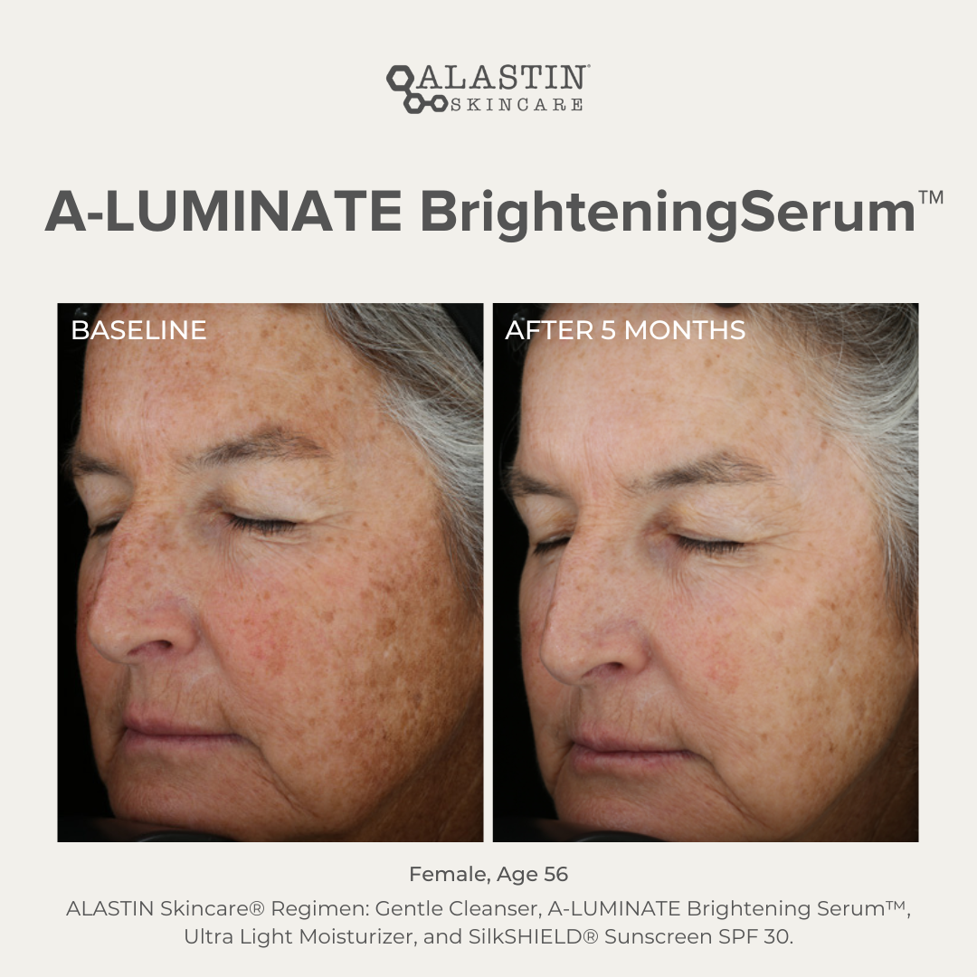 a-luminate brightening serum before and after