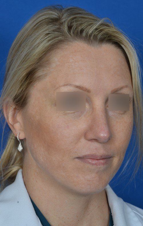 after female rhinoplasty