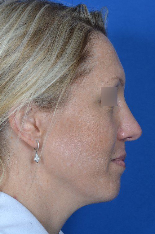 female rhinoplasty