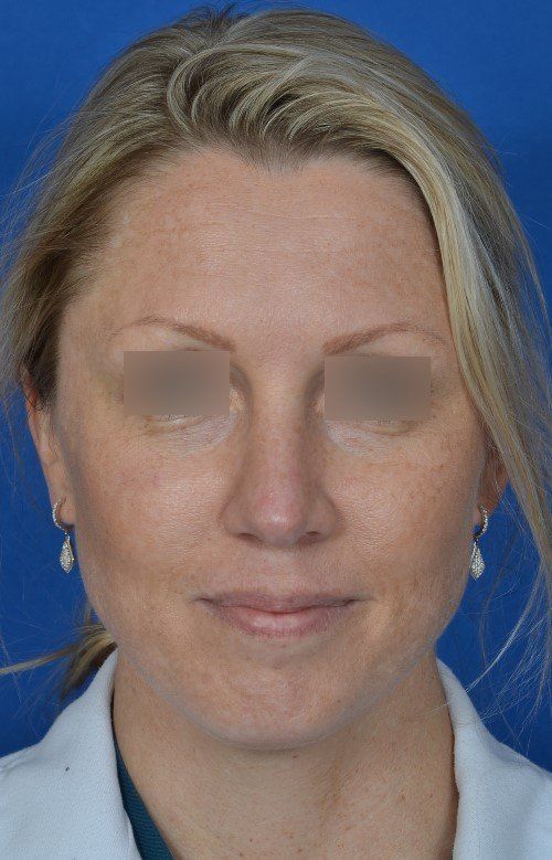 female rhinoplasty