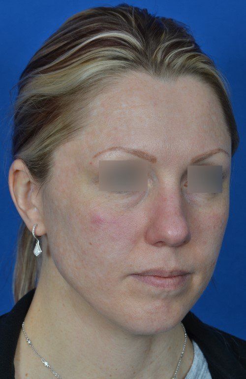 before female rhinoplasty