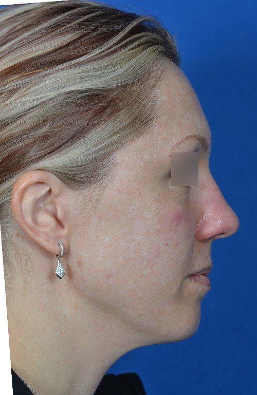female rhinoplasty