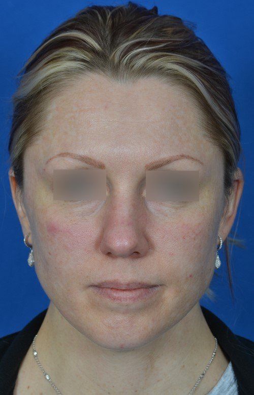 female rhinoplasty