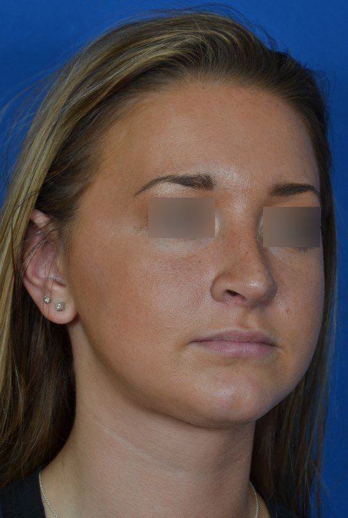 female rhinoplasty