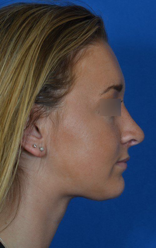 female rhinoplasty