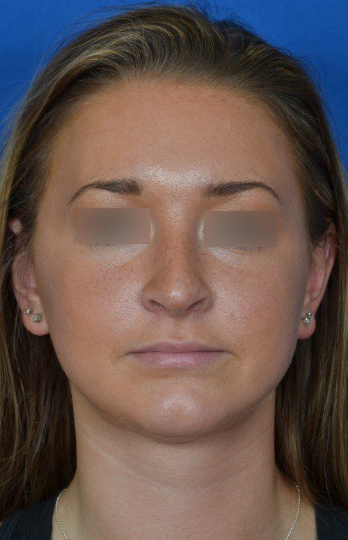 female rhinoplasty