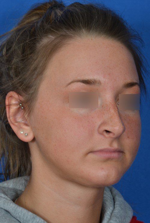 female rhinoplasty