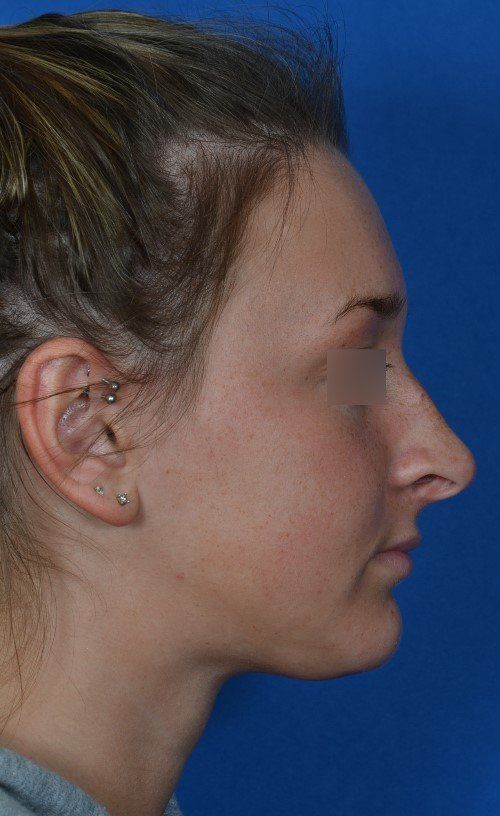 female rhinoplasty
