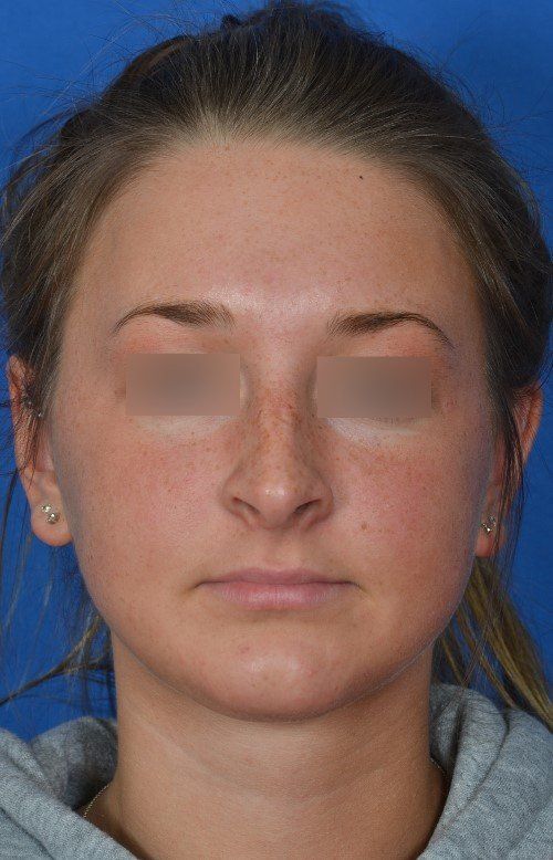 female rhinoplasty